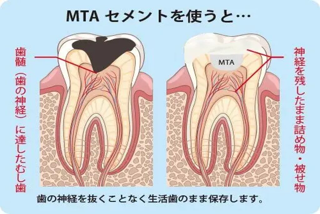 MTAセメントを使用した神経を守る歯科治療