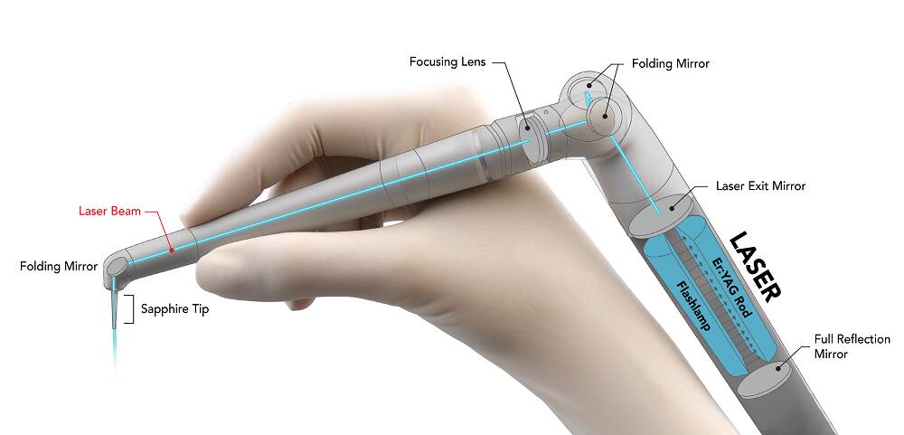 ライトタッチレーザー治療