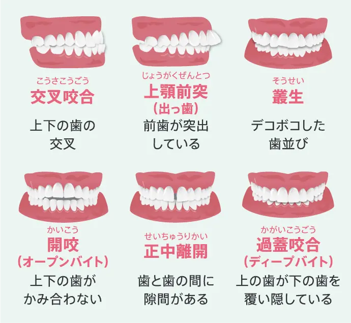 マウスピース矯正で治療可能な代表的な不正咬合(歯並びの乱れ)の解説図