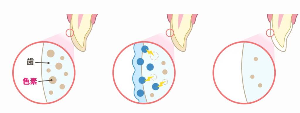 ホワイトニング薬剤が歯の色素を分解し、白くなっていく3つのプロセス図解