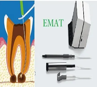 高周波を用いて根管内の細菌を殺菌・焼灼する高周波根管治療器(EMAT)のイメージ