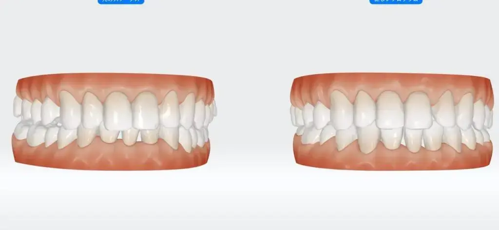 マウスピース矯正による治療前と治療後の3D歯並びシミュレーション比較画像