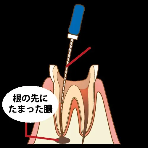根管治療において、ファイル(専用器具)を使用して歯の根の先に溜まった膿や汚染物質を取り除く様子