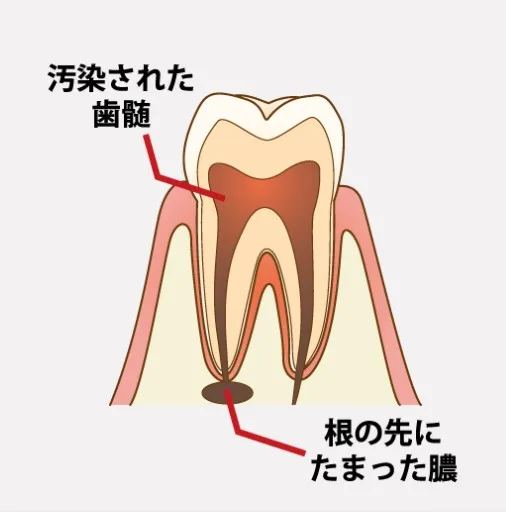 虫歯の進行により汚染された歯髄(神経)と、歯の根の先に溜まった膿の仕組みを説明するイラスト