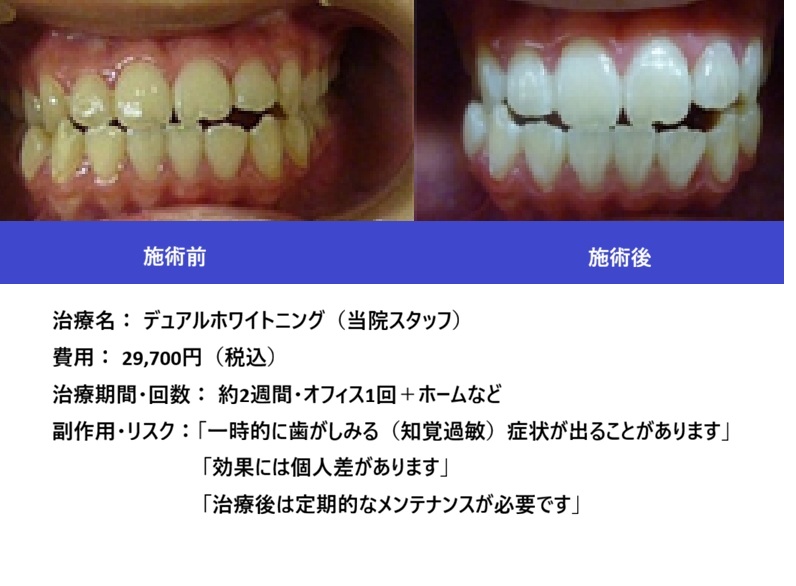 医院と自宅を併用するデュアルホワイトニング