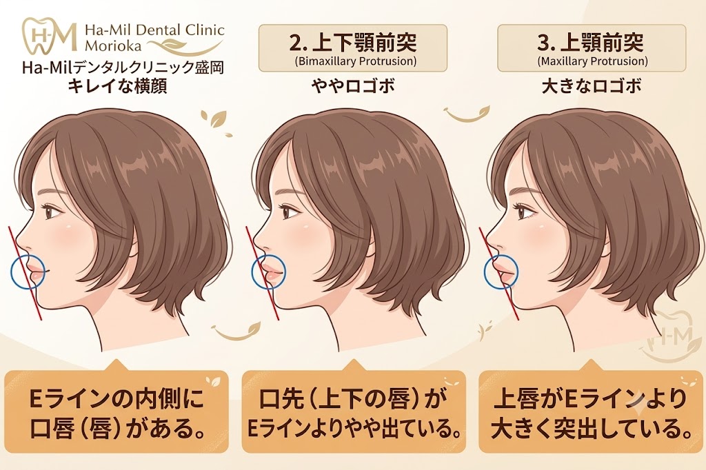 ロゴボ矯正(マウスピース矯正)